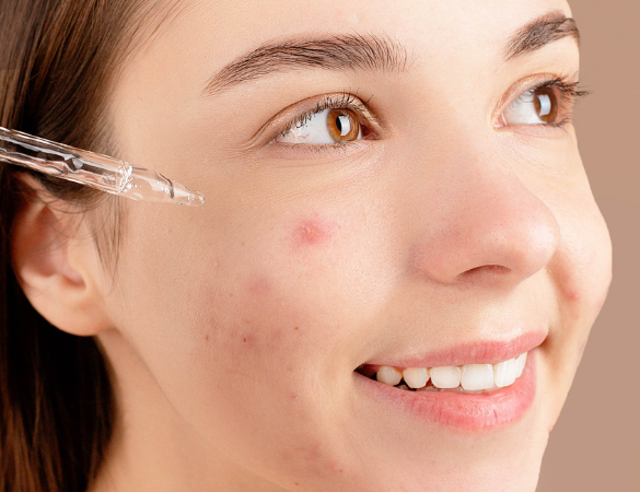 Acne Treatments