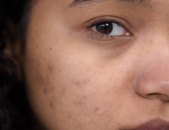 Pigmentation Treatments