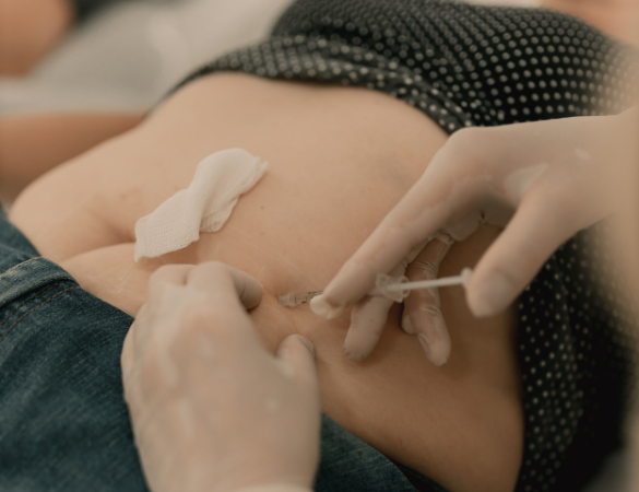 Fat Dissolving Treatments