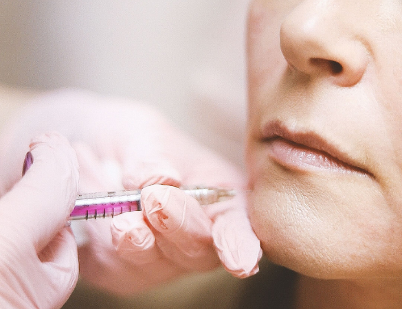 Marionette Line Filler
