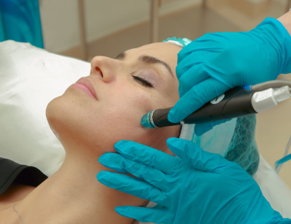 RF Microneedling